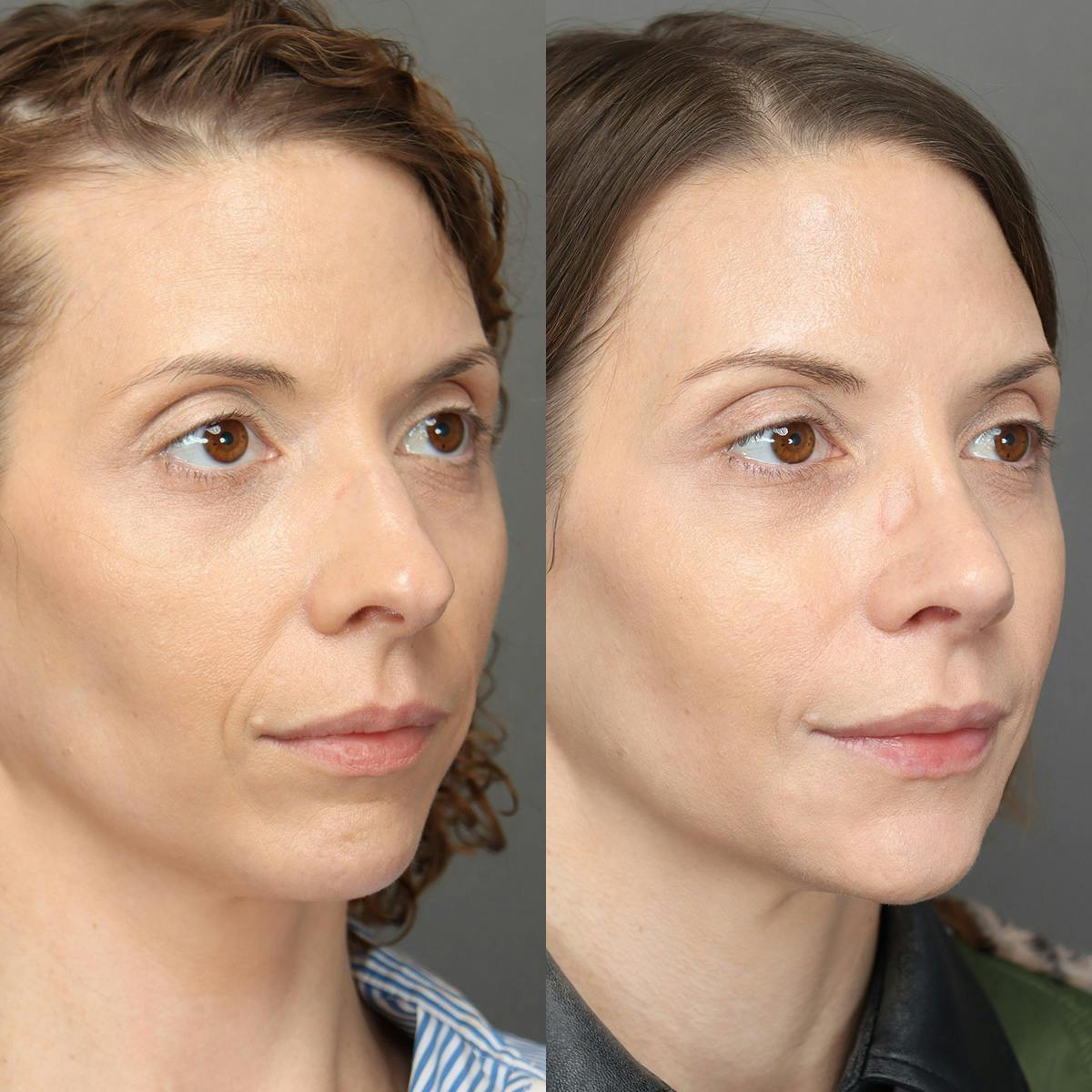 Rhinoplasty Before & After Gallery - Patient 583868 - Image 1