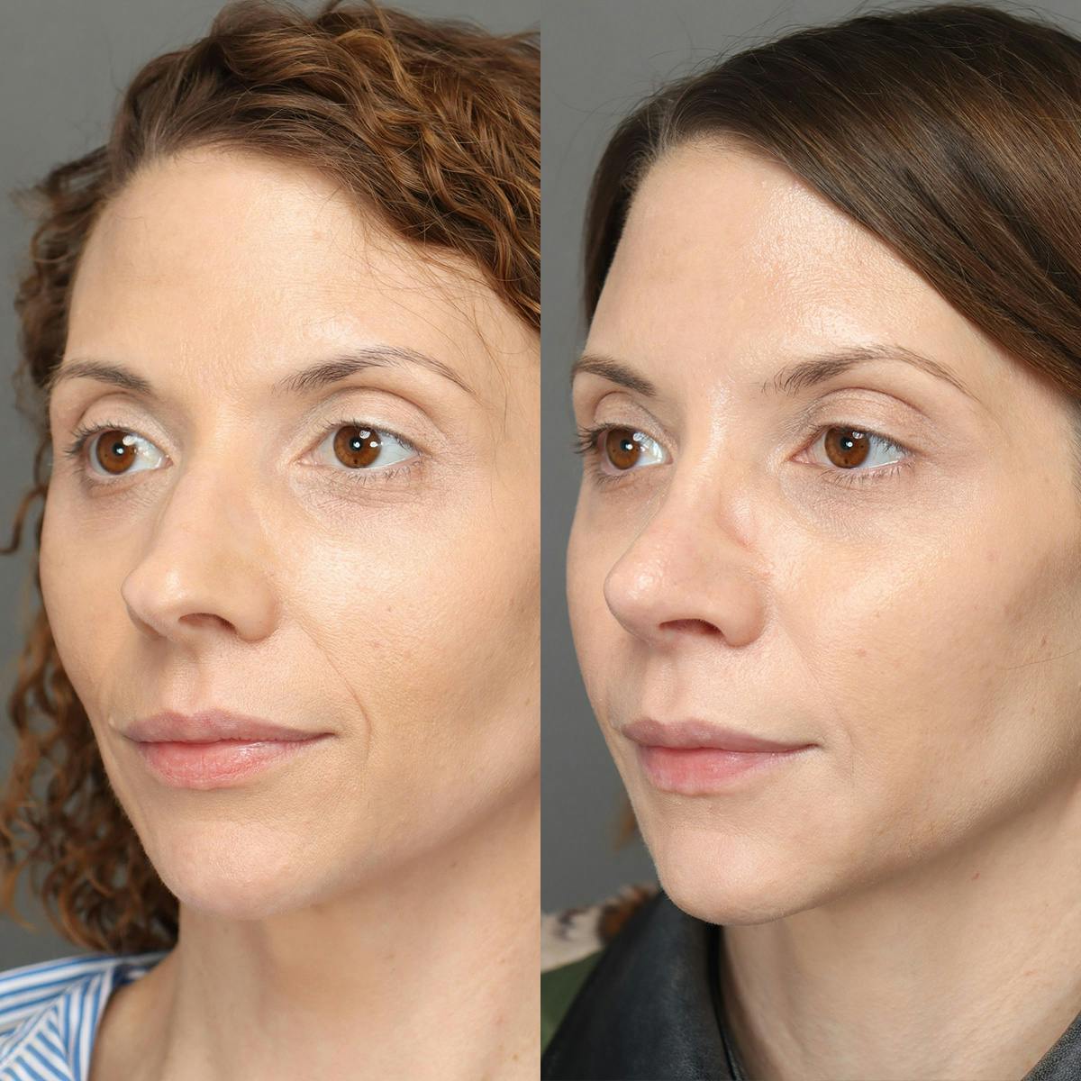 Rhinoplasty Before & After Gallery - Patient 583868 - Image 3