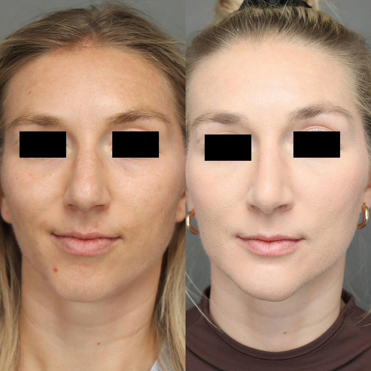 Rhinoplasty Before & After Gallery - Patient 264473 - Image 3