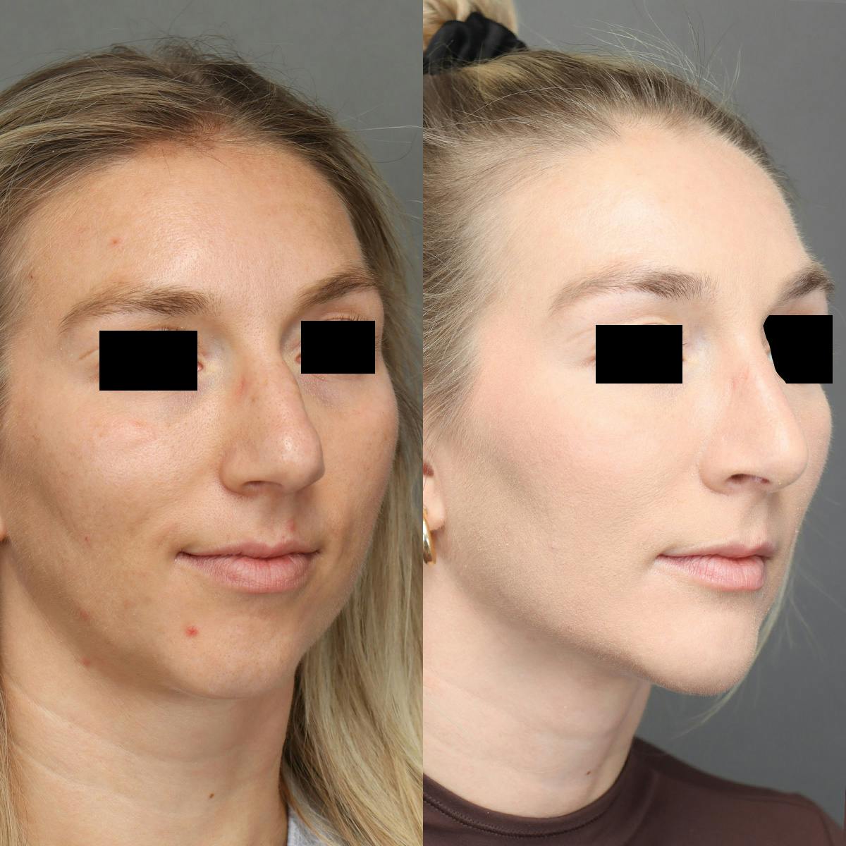 Rhinoplasty Before & After Gallery - Patient 264473 - Image 2
