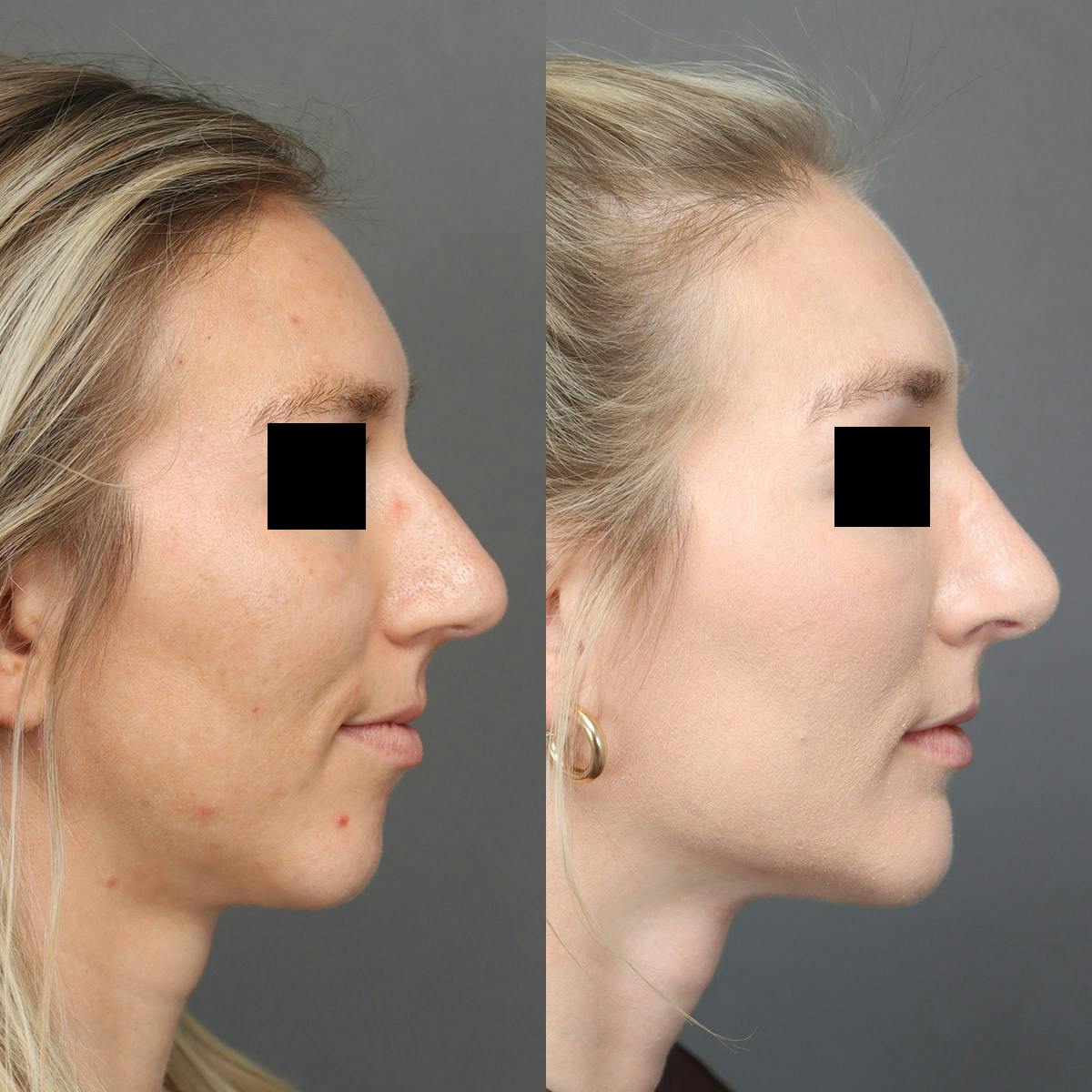 Rhinoplasty Before & After Gallery - Patient 264473 - Image 1