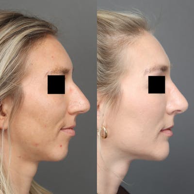 Rhinoplasty Before & After Gallery - Patient 264473 - Image 1