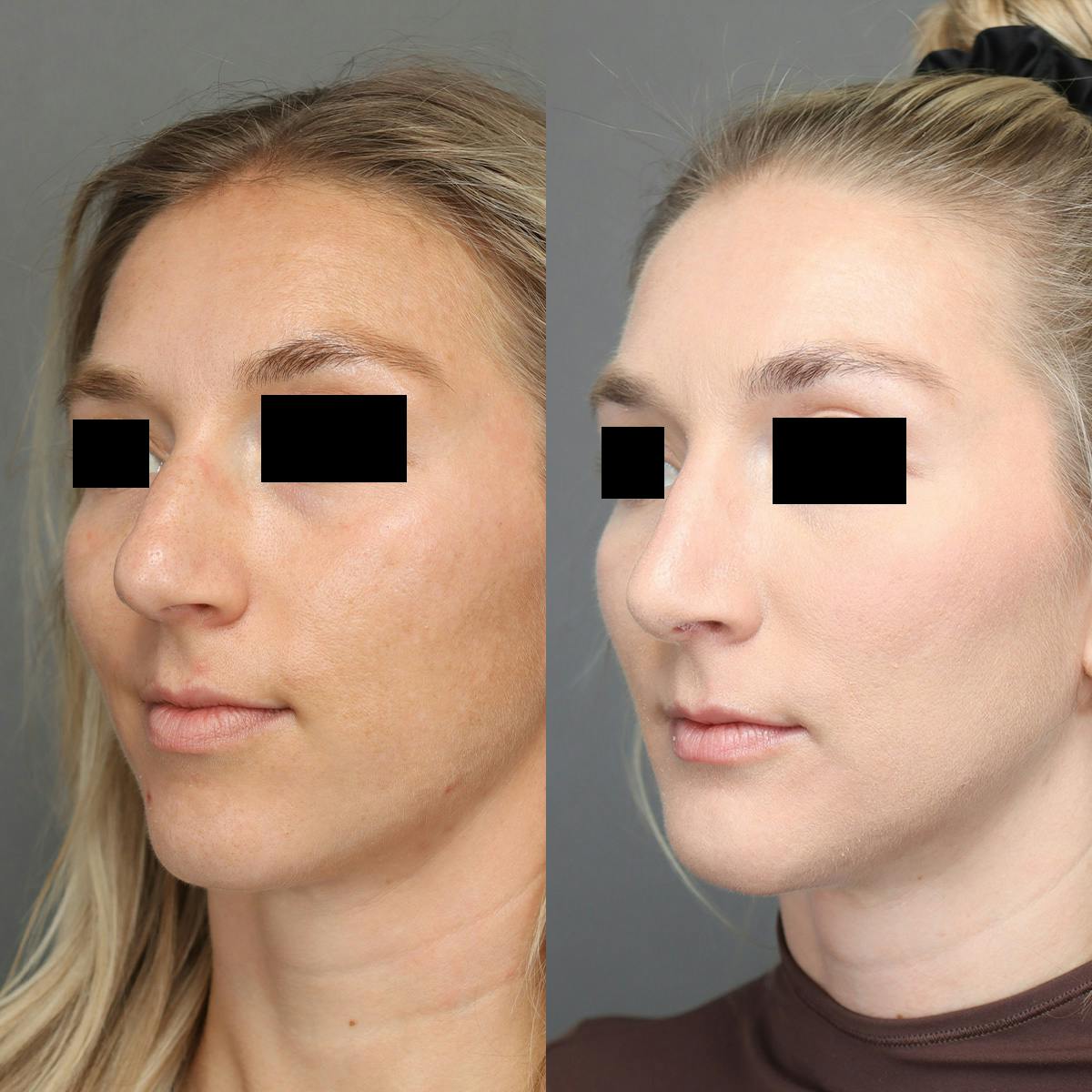Rhinoplasty Before & After Gallery - Patient 264473 - Image 5