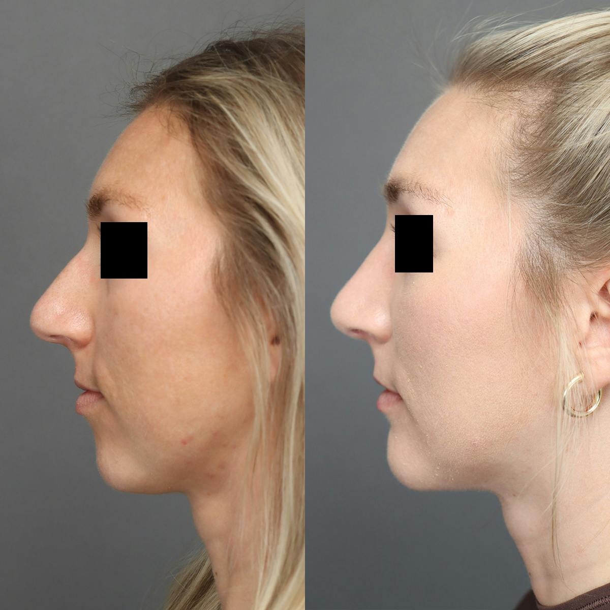 Rhinoplasty Before & After Gallery - Patient 264473 - Image 4