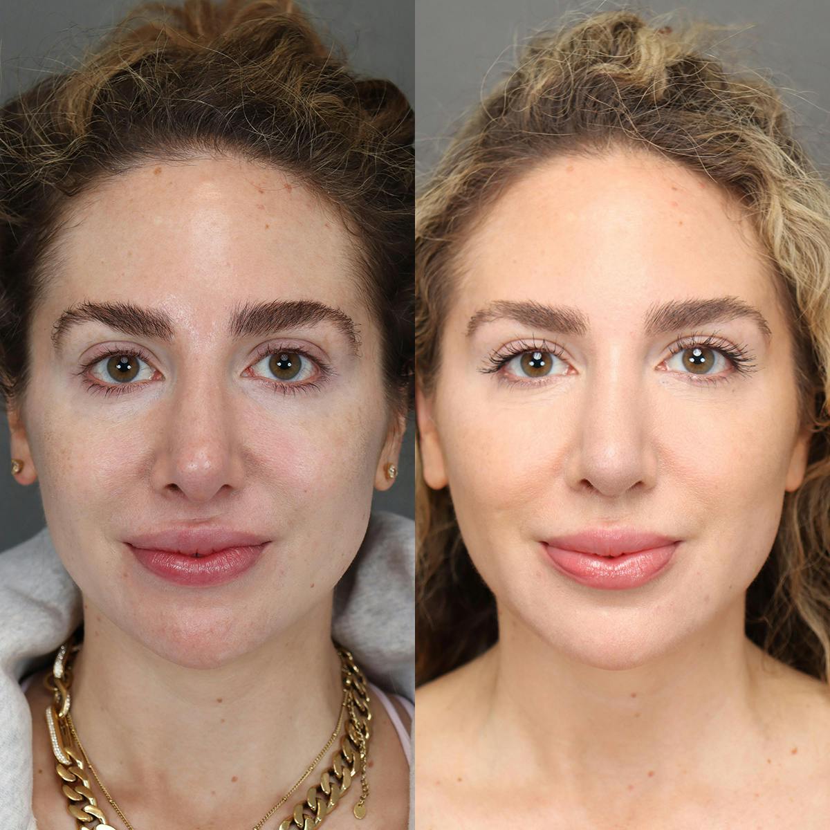 Rhinoplasty Before & After Gallery - Patient 595052 - Image 3