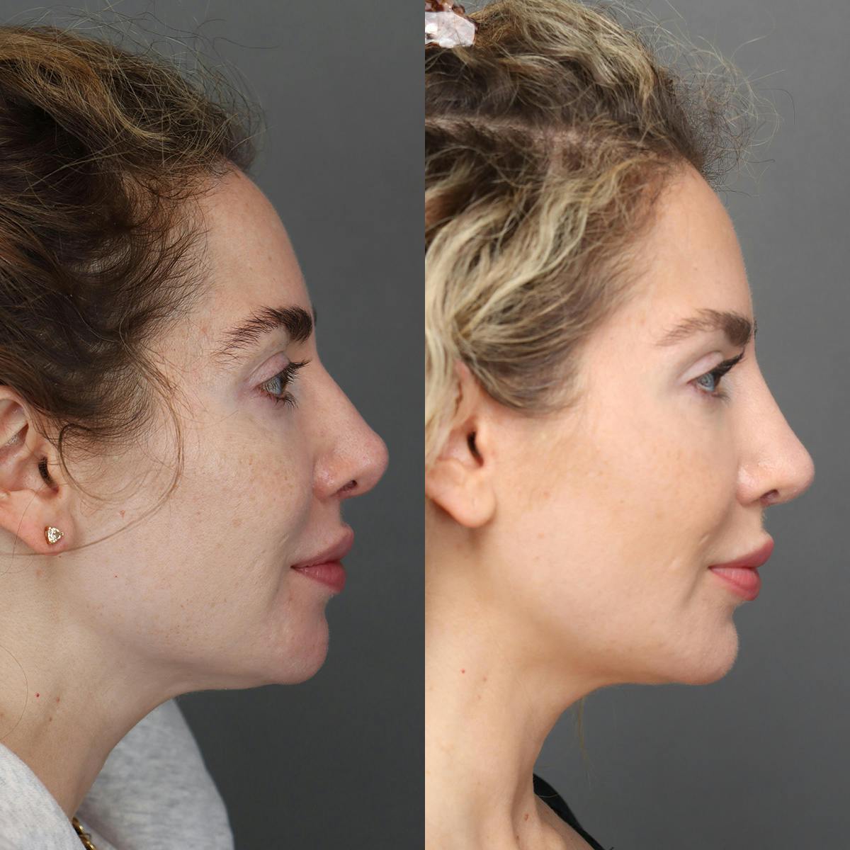 Rhinoplasty Before & After Gallery - Patient 595052 - Image 1