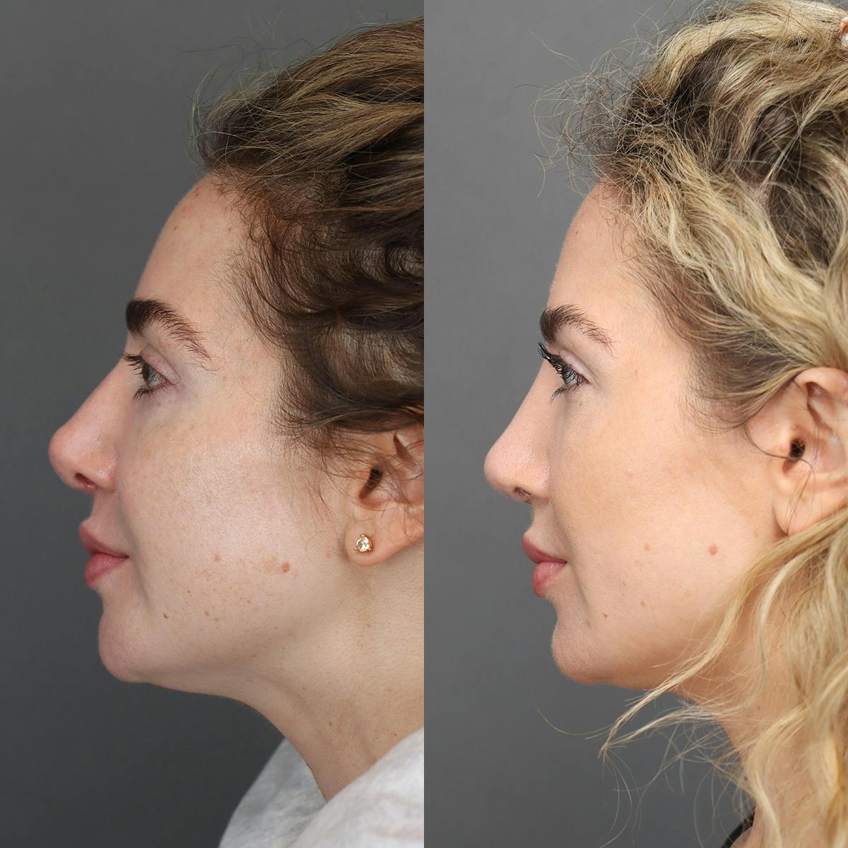 Rhinoplasty Before & After Gallery - Patient 595052 - Image 4