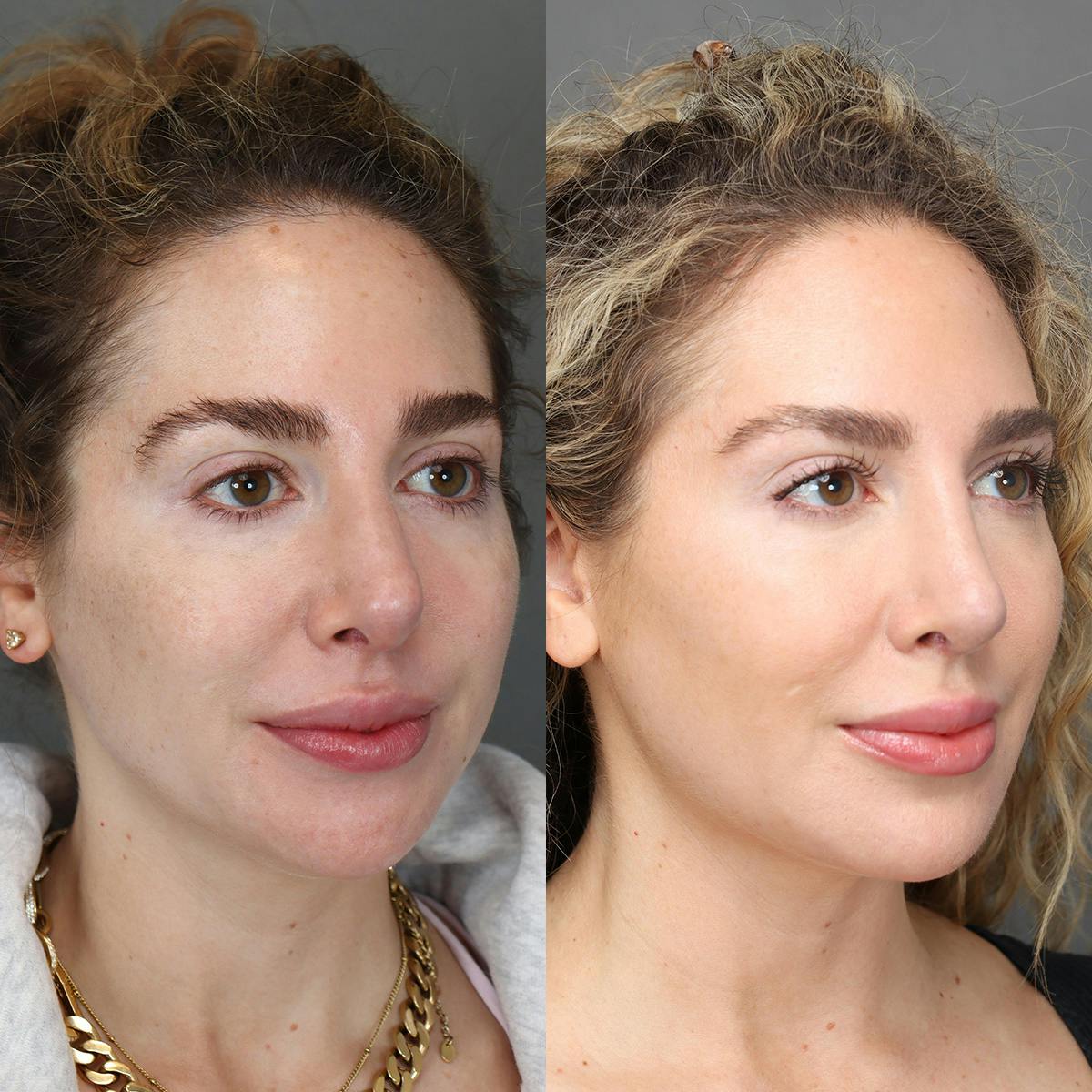 Rhinoplasty Before & After Gallery - Patient 595052 - Image 2