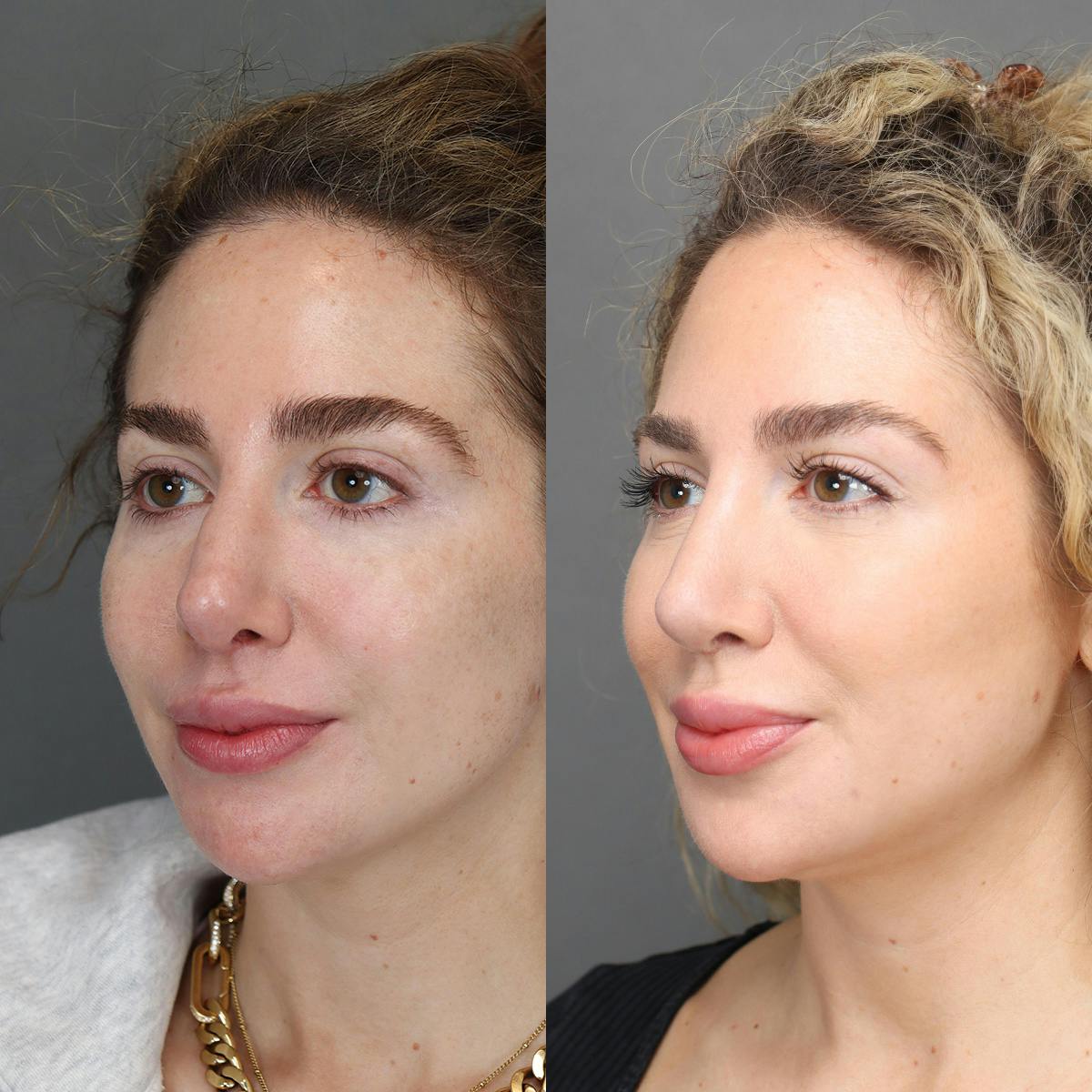 Rhinoplasty Before & After Gallery - Patient 595052 - Image 5