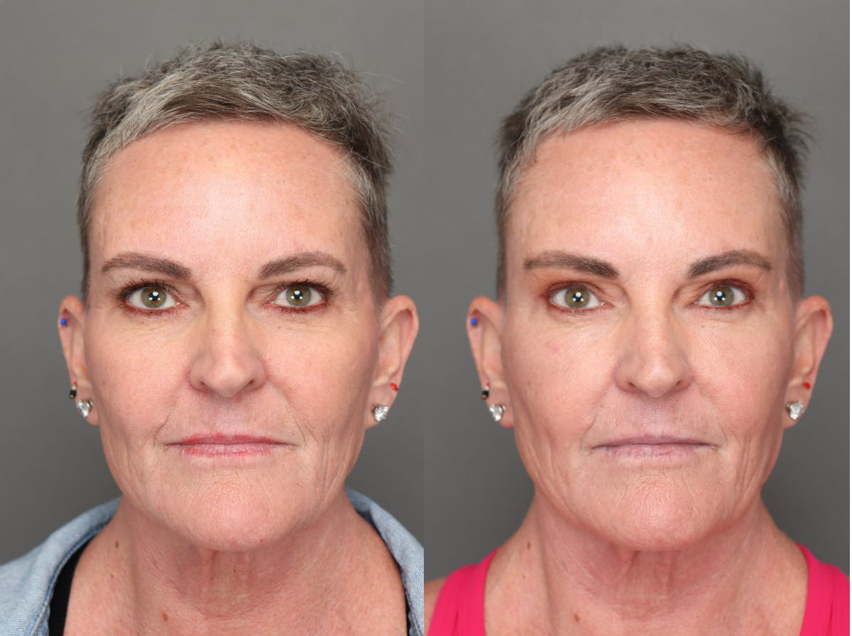 Brow Lifts Before & After Gallery - Patient 181865 - Image 1