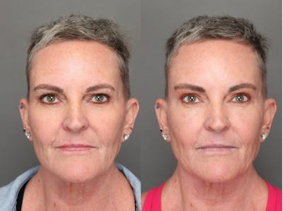 Brow Lifts Before & After Gallery - Patient 181865 - Image 1