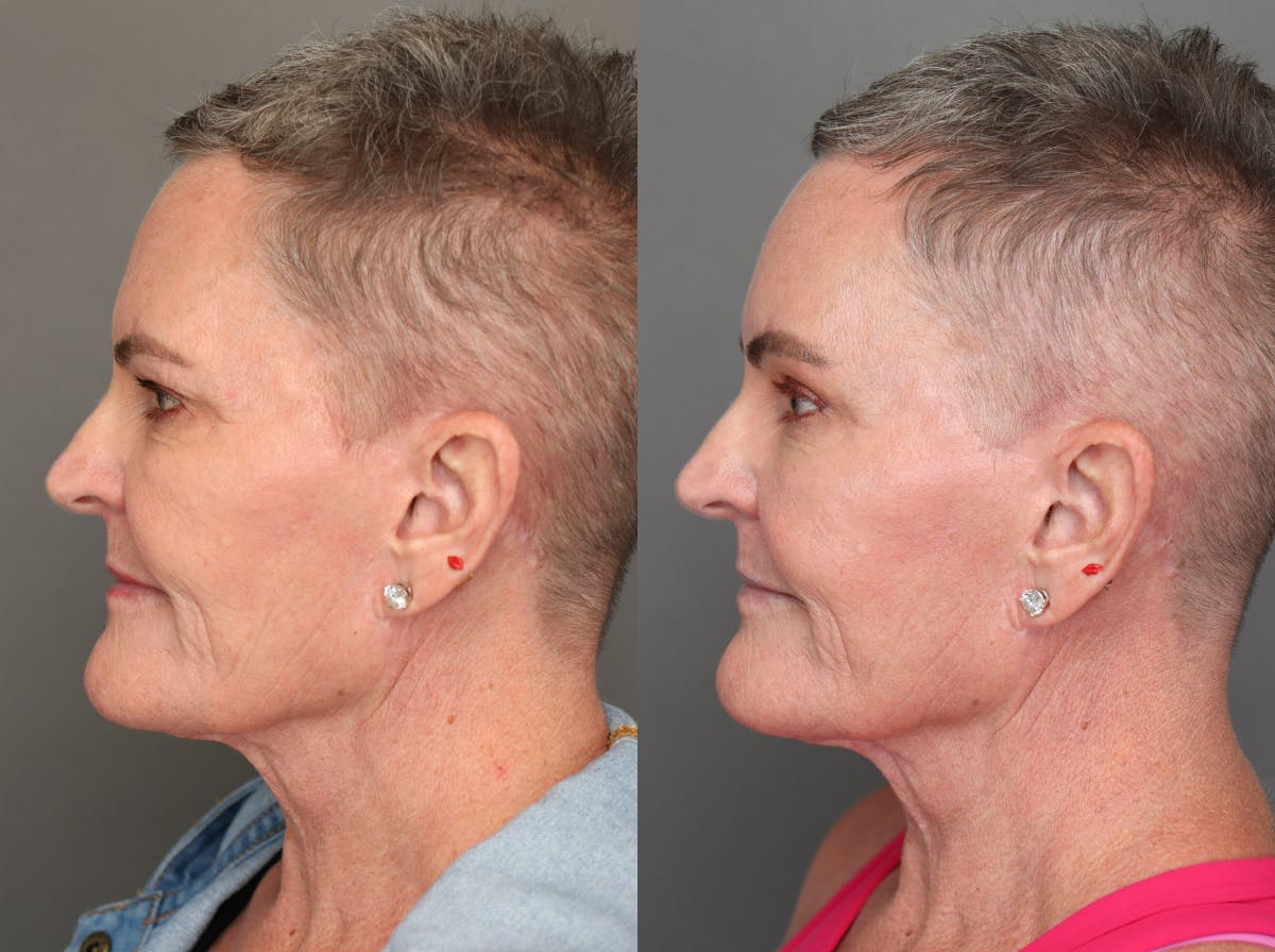 Brow Lifts Before & After Gallery - Patient 181865 - Image 5