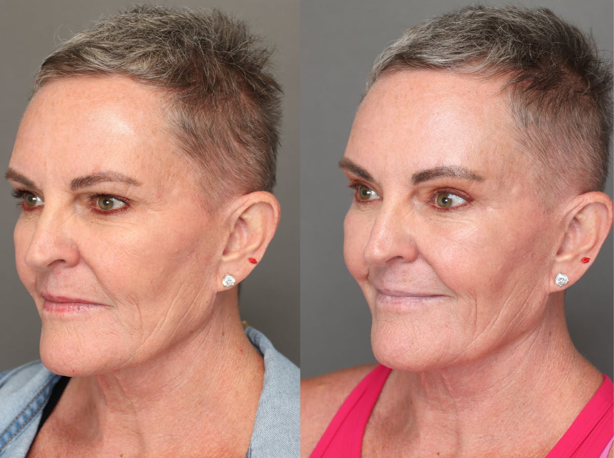 Brow Lifts Before & After Gallery - Patient 181865 - Image 4