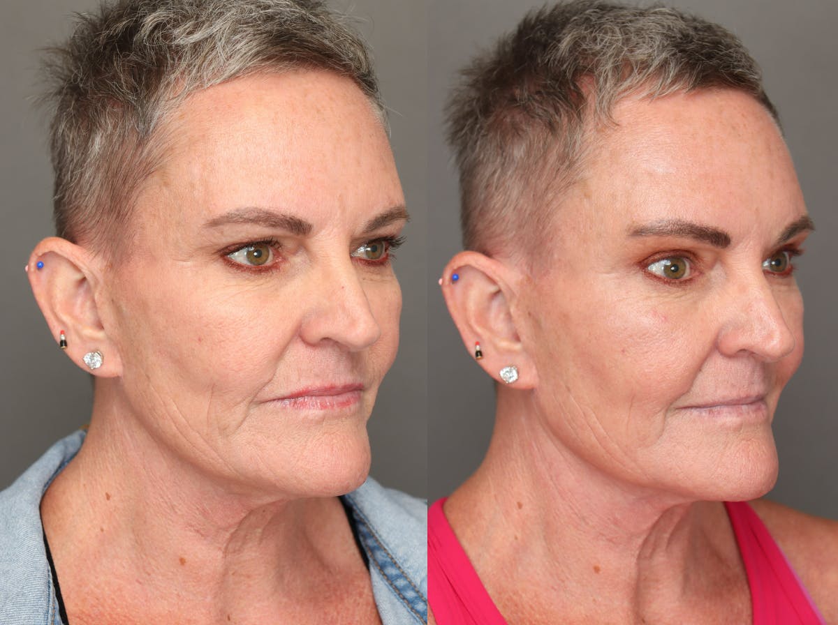 Brow Lifts Before & After Gallery - Patient 181865 - Image 2
