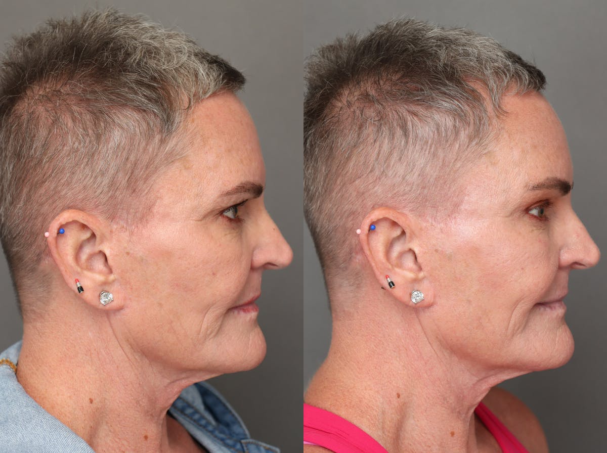Brow Lifts Before & After Gallery - Patient 181865 - Image 3