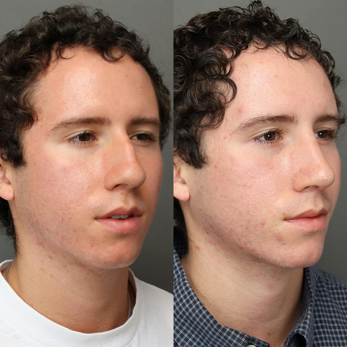 Rhinoplasty Before & After Gallery - Patient 178106 - Image 2