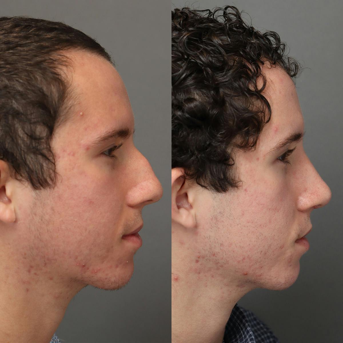 Rhinoplasty Before & After Gallery - Patient 178106 - Image 1