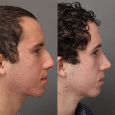 Rhinoplasty Before & After Gallery - Patient 178106 - Image 1