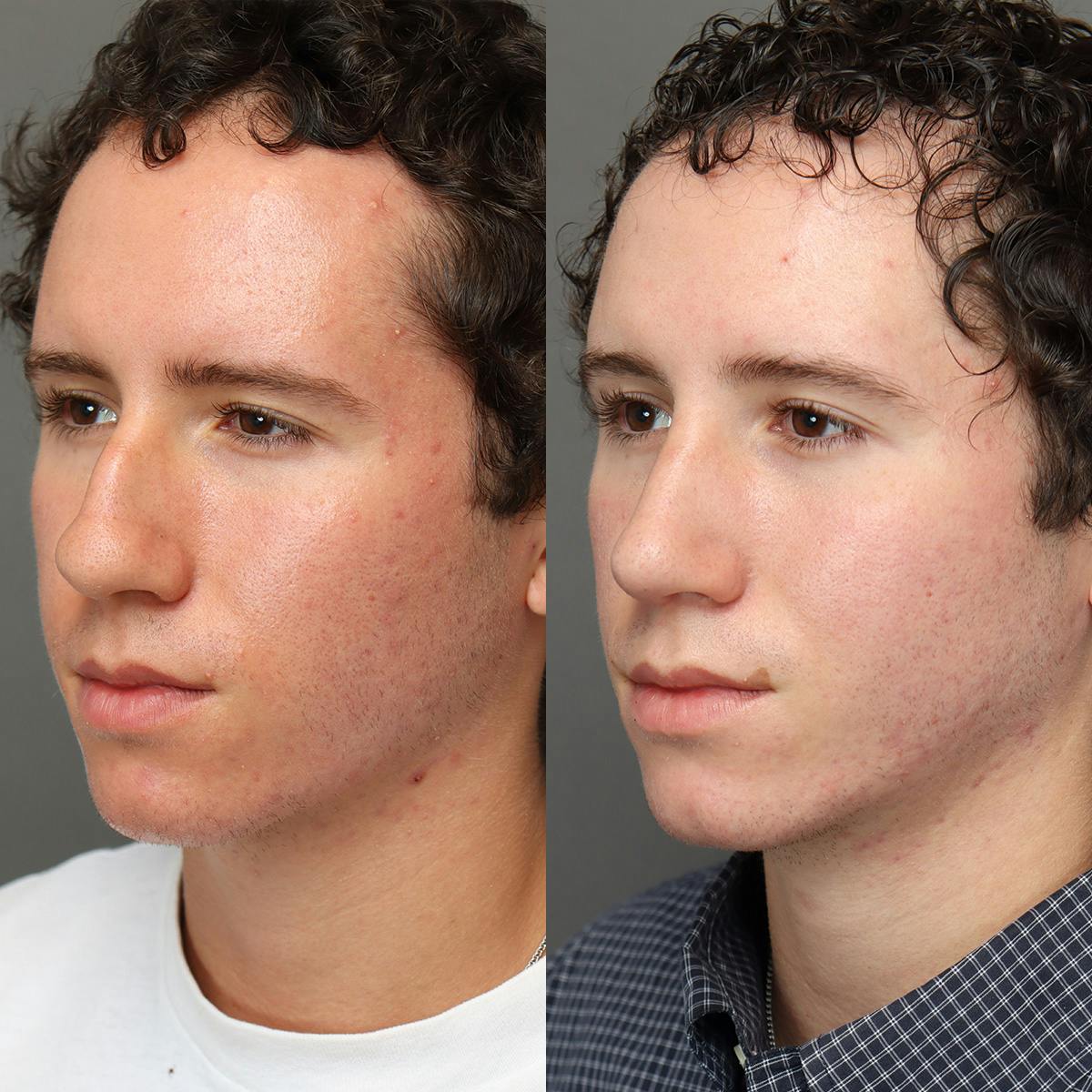 Rhinoplasty Before & After Gallery - Patient 178106 - Image 4