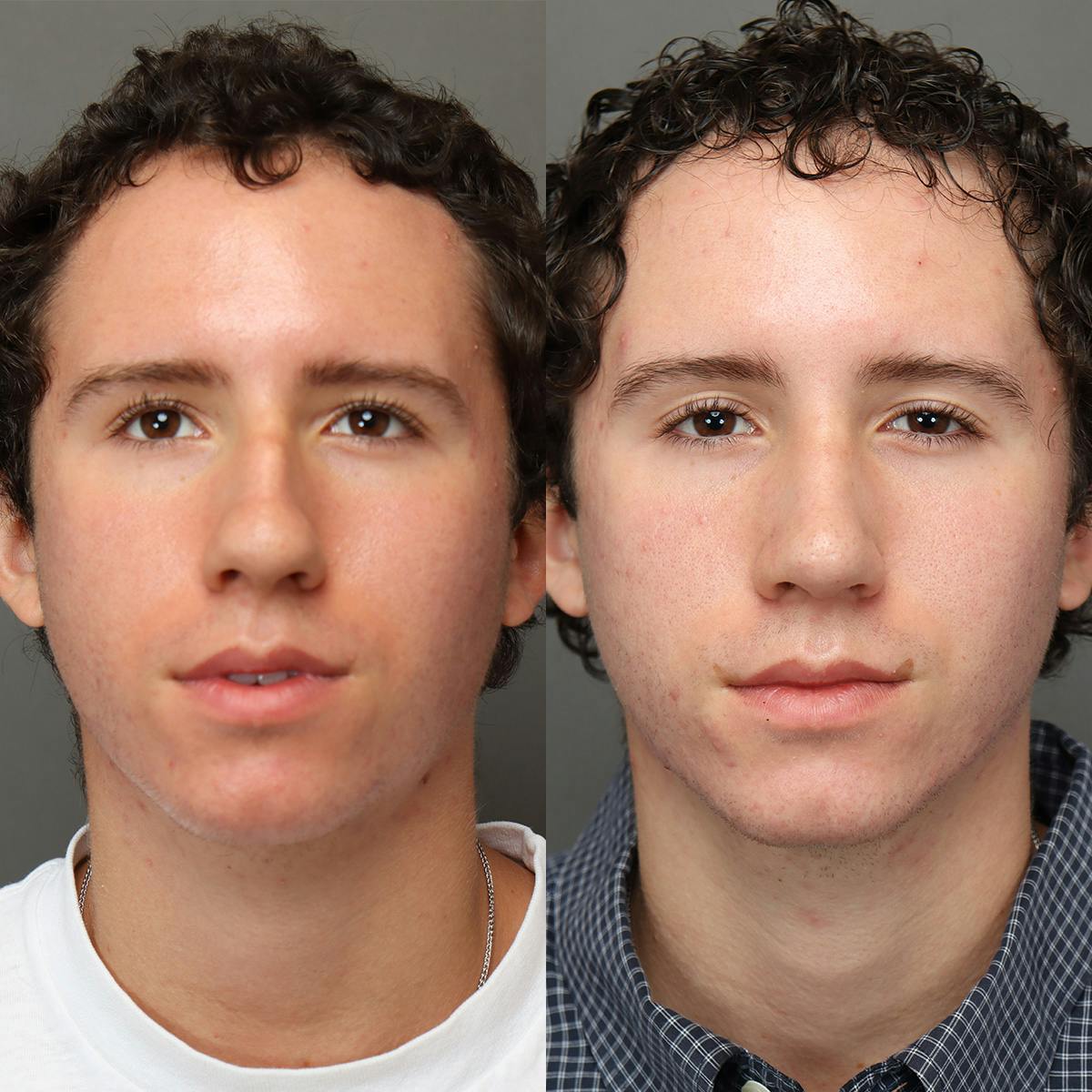 Rhinoplasty Before & After Gallery - Patient 178106 - Image 3