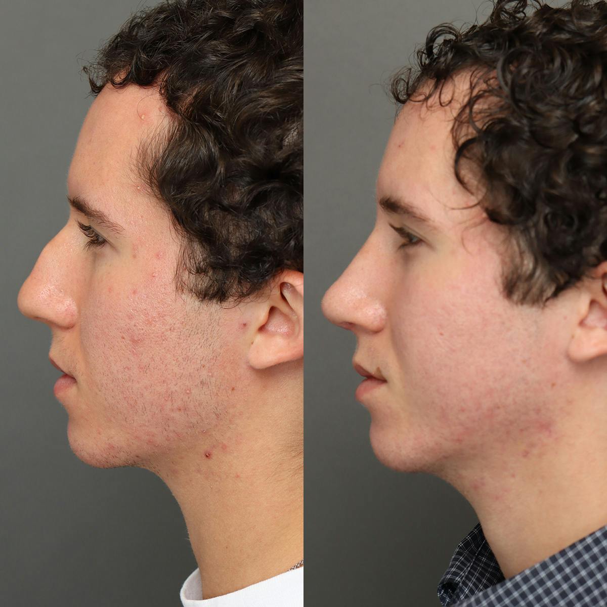 Rhinoplasty Before & After Gallery - Patient 178106 - Image 5