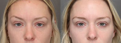 Eyelifts & Blepharoplasty Before & After Gallery - Patient 646965 - Image 1