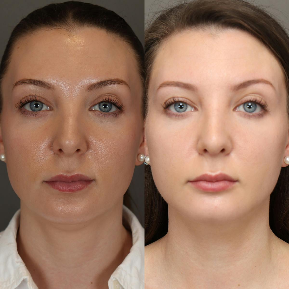 Rhinoplasty Before & After Gallery - Patient 250645 - Image 3