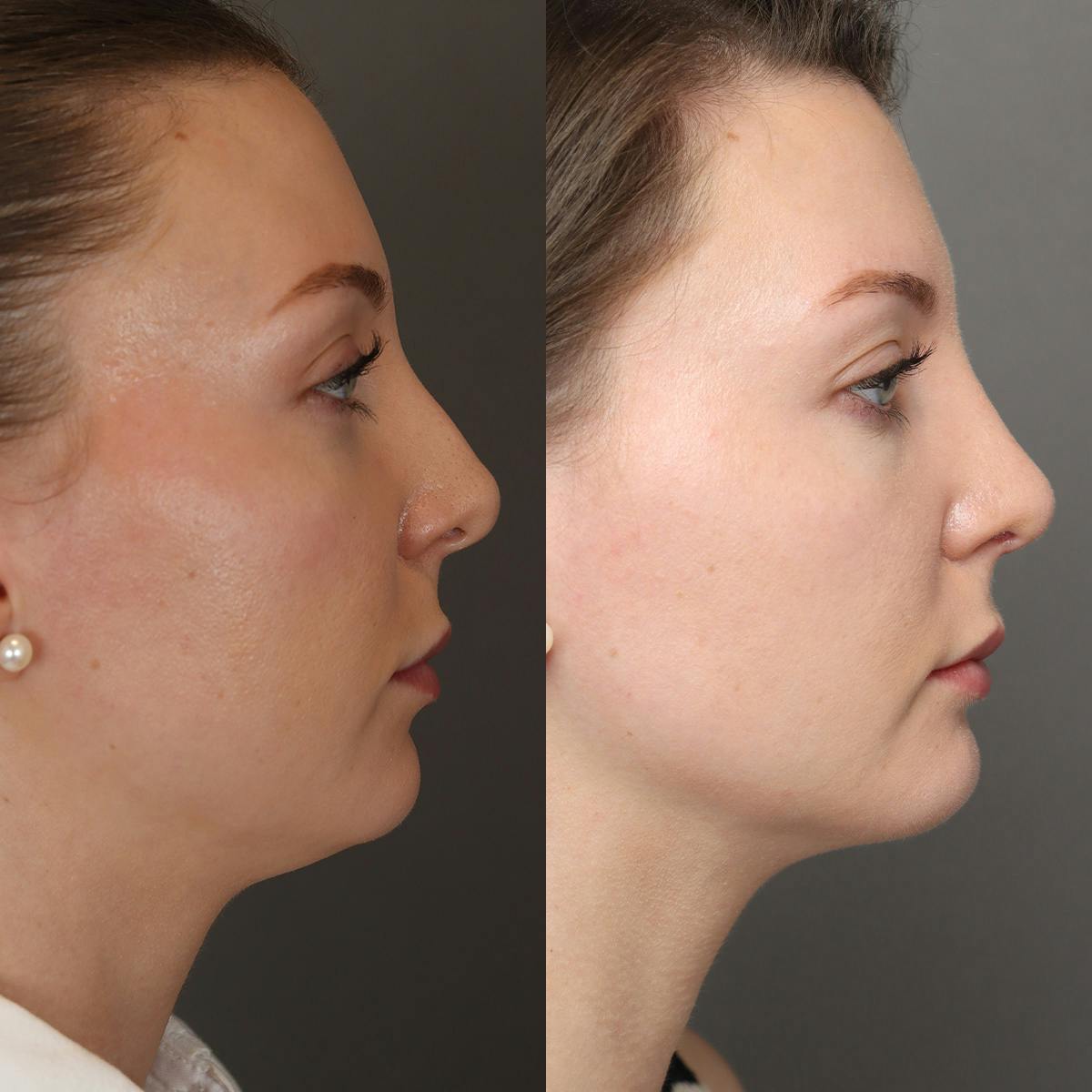 Rhinoplasty Before & After Gallery - Patient 250645 - Image 1