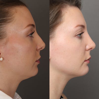 Rhinoplasty Before & After Gallery - Patient 250645 - Image 1