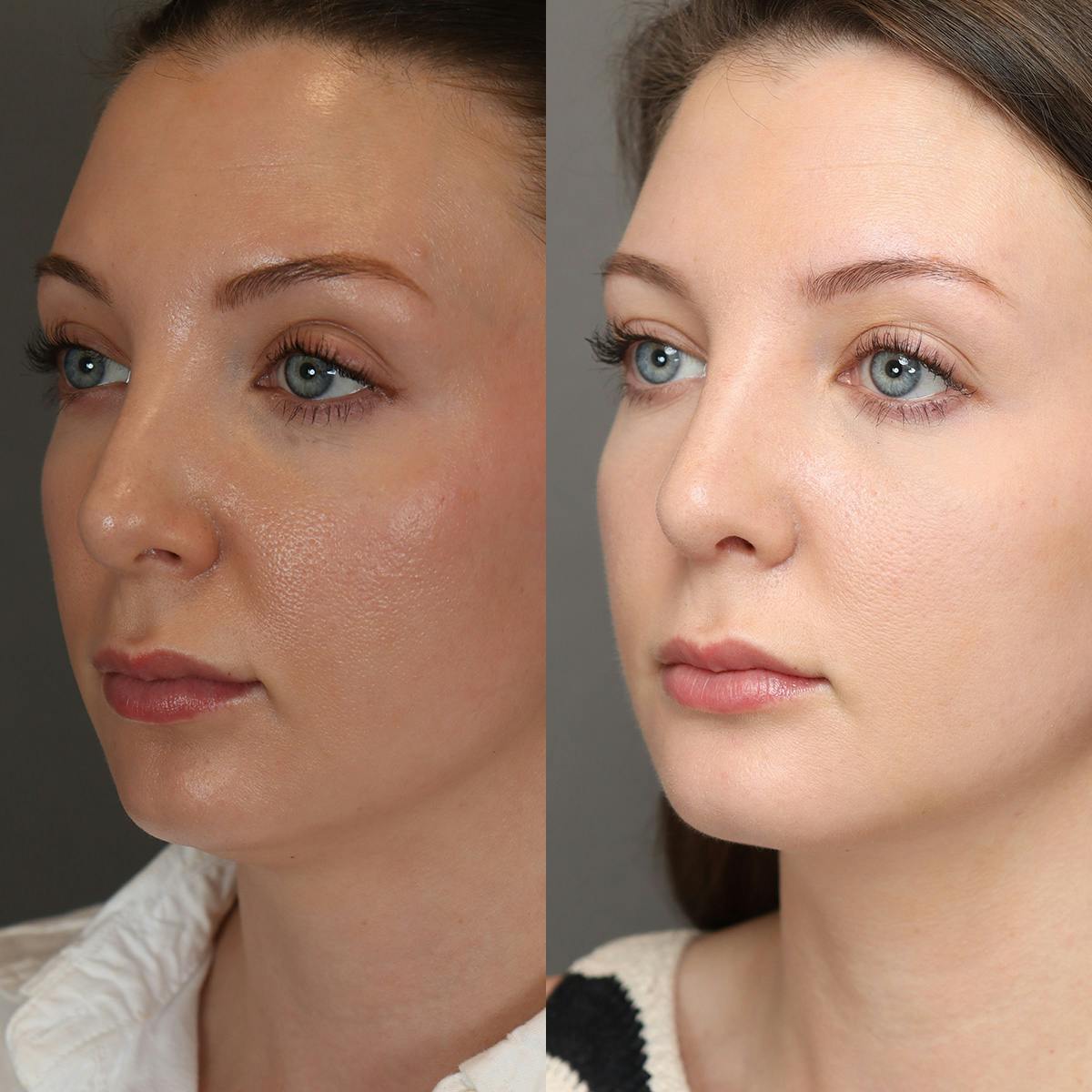 Rhinoplasty Before & After Gallery - Patient 250645 - Image 4