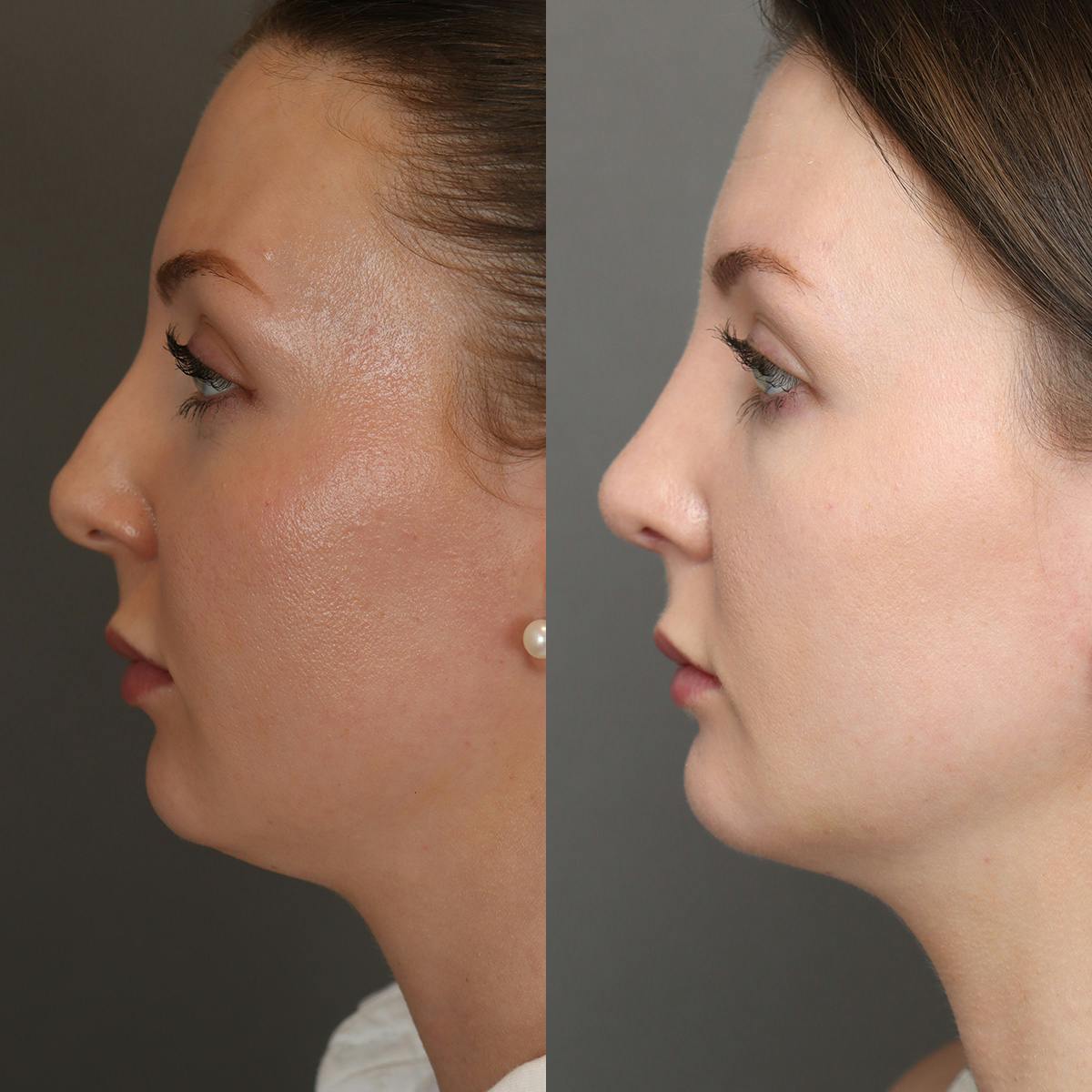 Rhinoplasty Before & After Gallery - Patient 250645 - Image 5