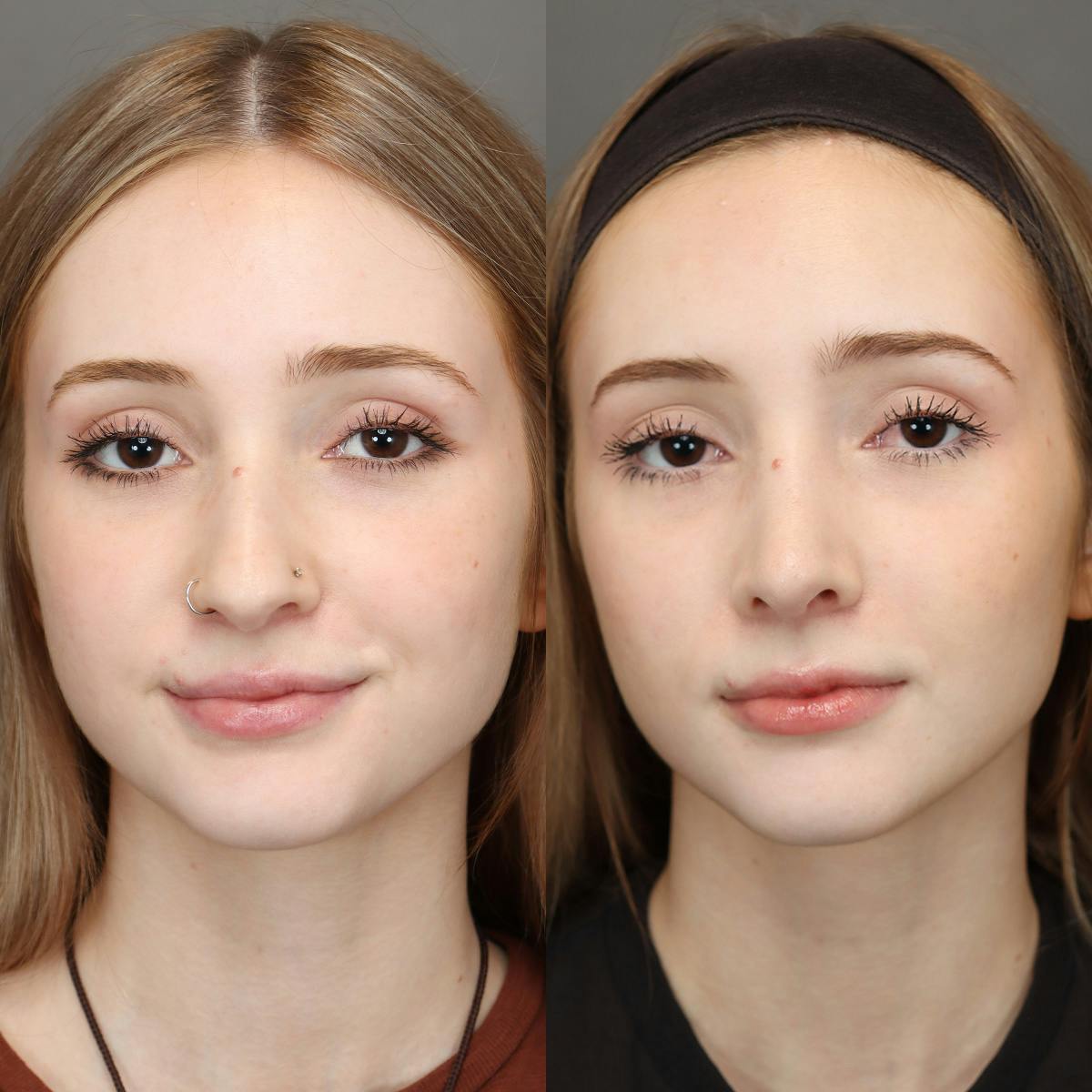 Rhinoplasty Before & After Gallery - Patient 271069 - Image 3