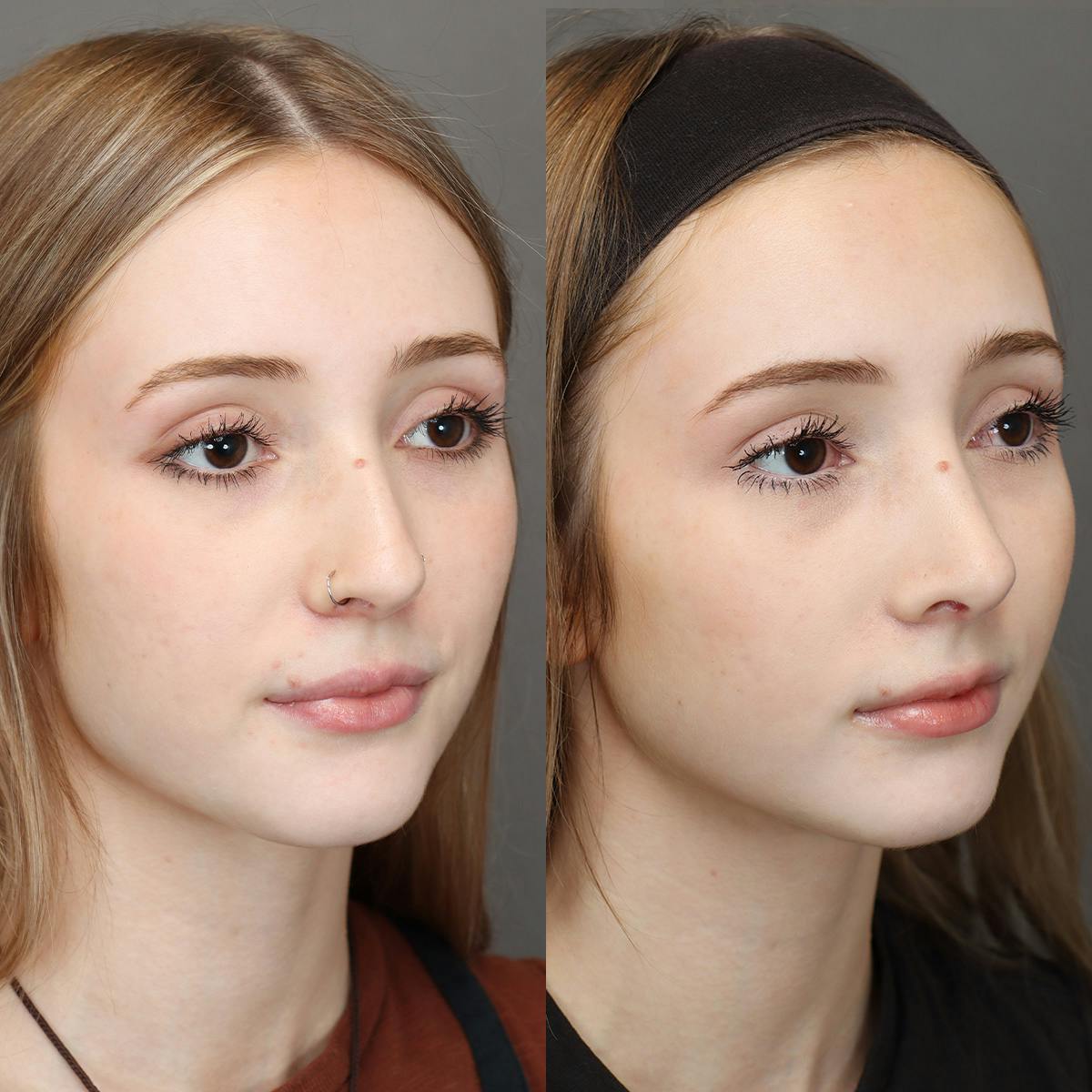 Rhinoplasty Before & After Gallery - Patient 271069 - Image 2