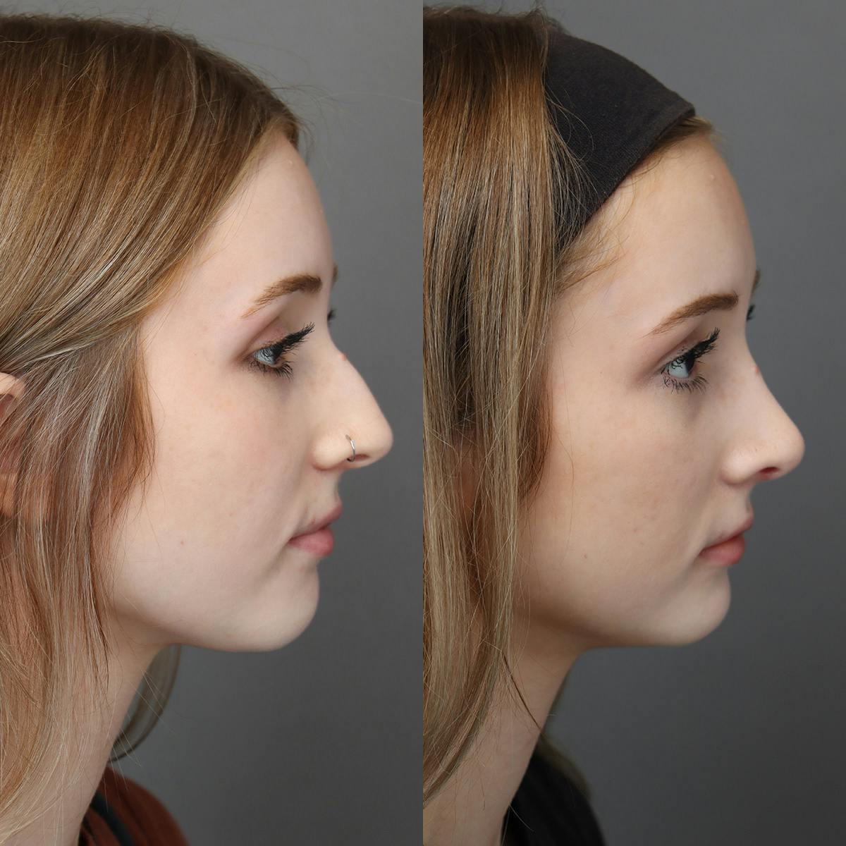 Rhinoplasty Before & After Gallery - Patient 271069 - Image 1