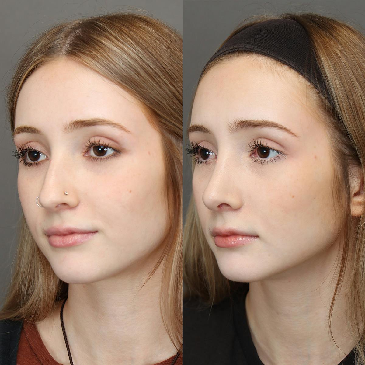 Rhinoplasty Before & After Gallery - Patient 271069 - Image 4