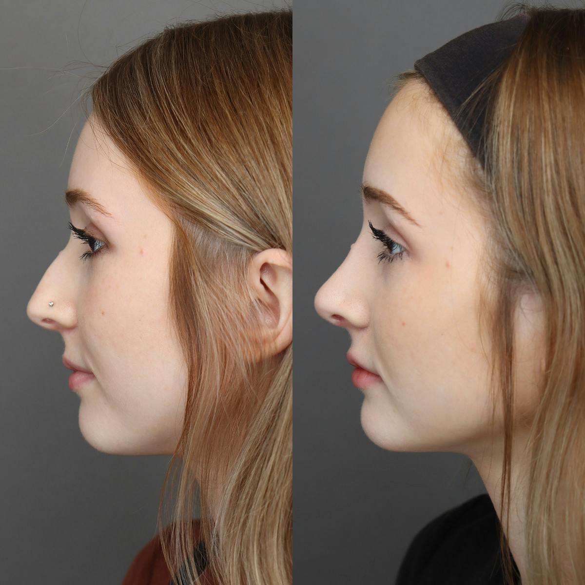 Rhinoplasty Before & After Gallery - Patient 271069 - Image 5