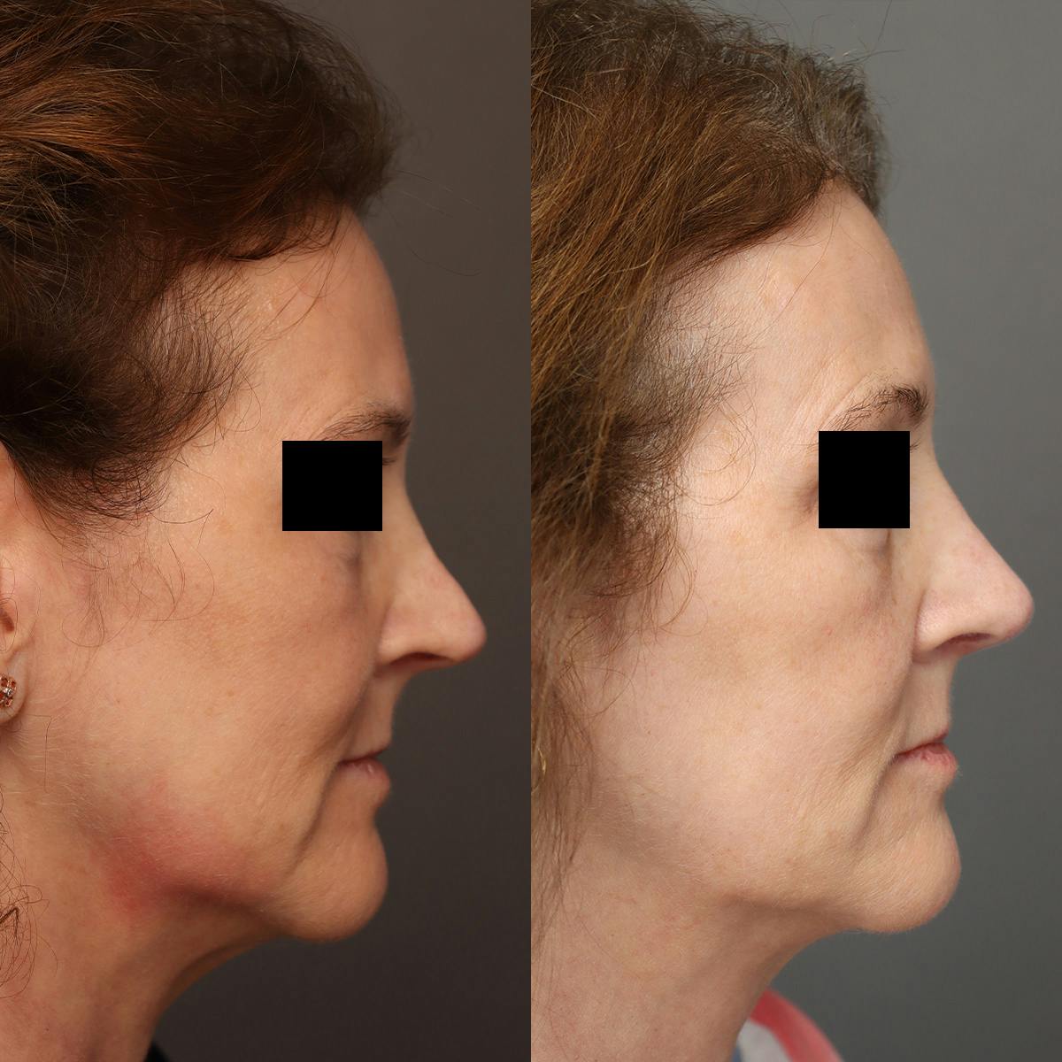 Rhinoplasty Before & After Gallery - Patient 174341 - Image 1