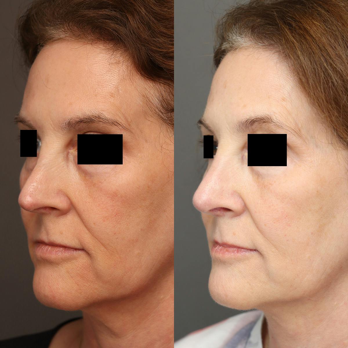 Rhinoplasty Before & After Gallery - Patient 174341 - Image 4