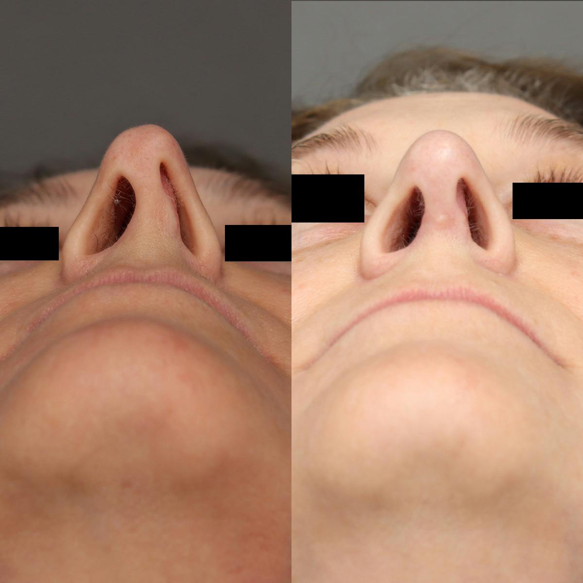Rhinoplasty Before & After Gallery - Patient 174341 - Image 5