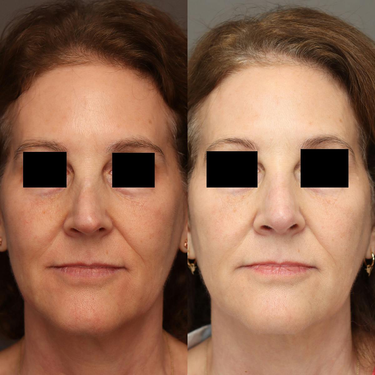 Rhinoplasty Before & After Gallery - Patient 174341 - Image 3