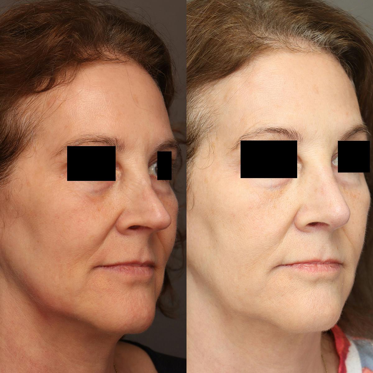Rhinoplasty Before & After Gallery - Patient 174341 - Image 2