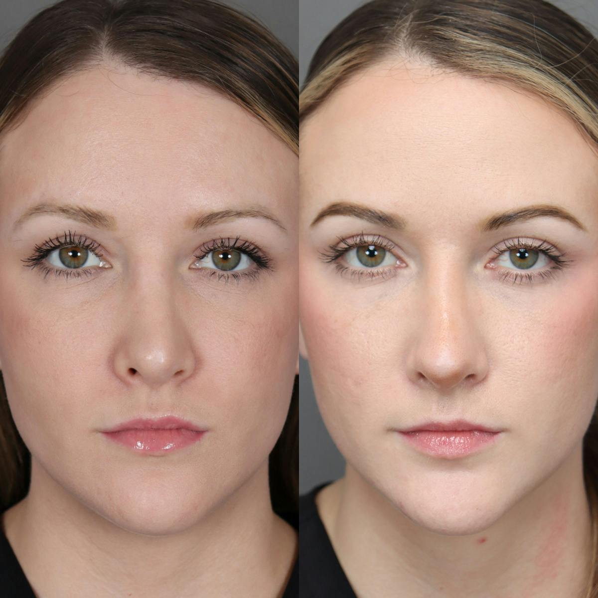 Revision Rhinoplasty Before & After Gallery - Patient 132913 - Image 3