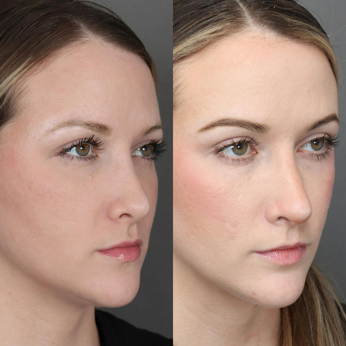 Revision Rhinoplasty Before & After Gallery - Patient 132913 - Image 2