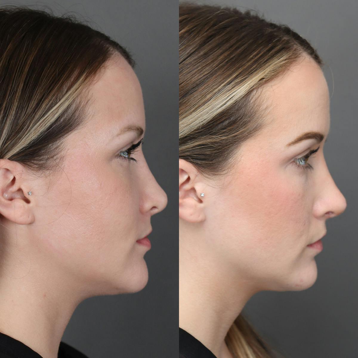 Revision Rhinoplasty Before & After Gallery - Patient 132913 - Image 1