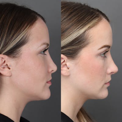 Revision Rhinoplasty Before & After Gallery - Patient 132913 - Image 1