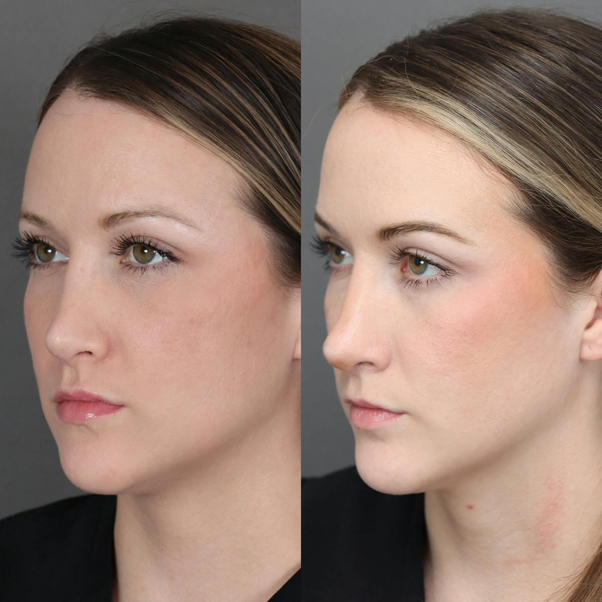 Revision Rhinoplasty Before & After Gallery - Patient 132913 - Image 4