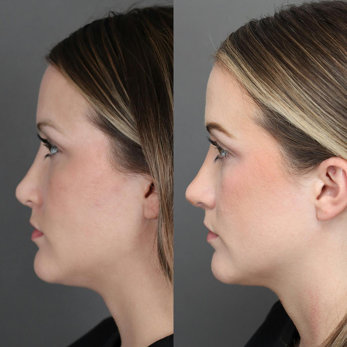 Revision Rhinoplasty Before & After Gallery - Patient 132913 - Image 5