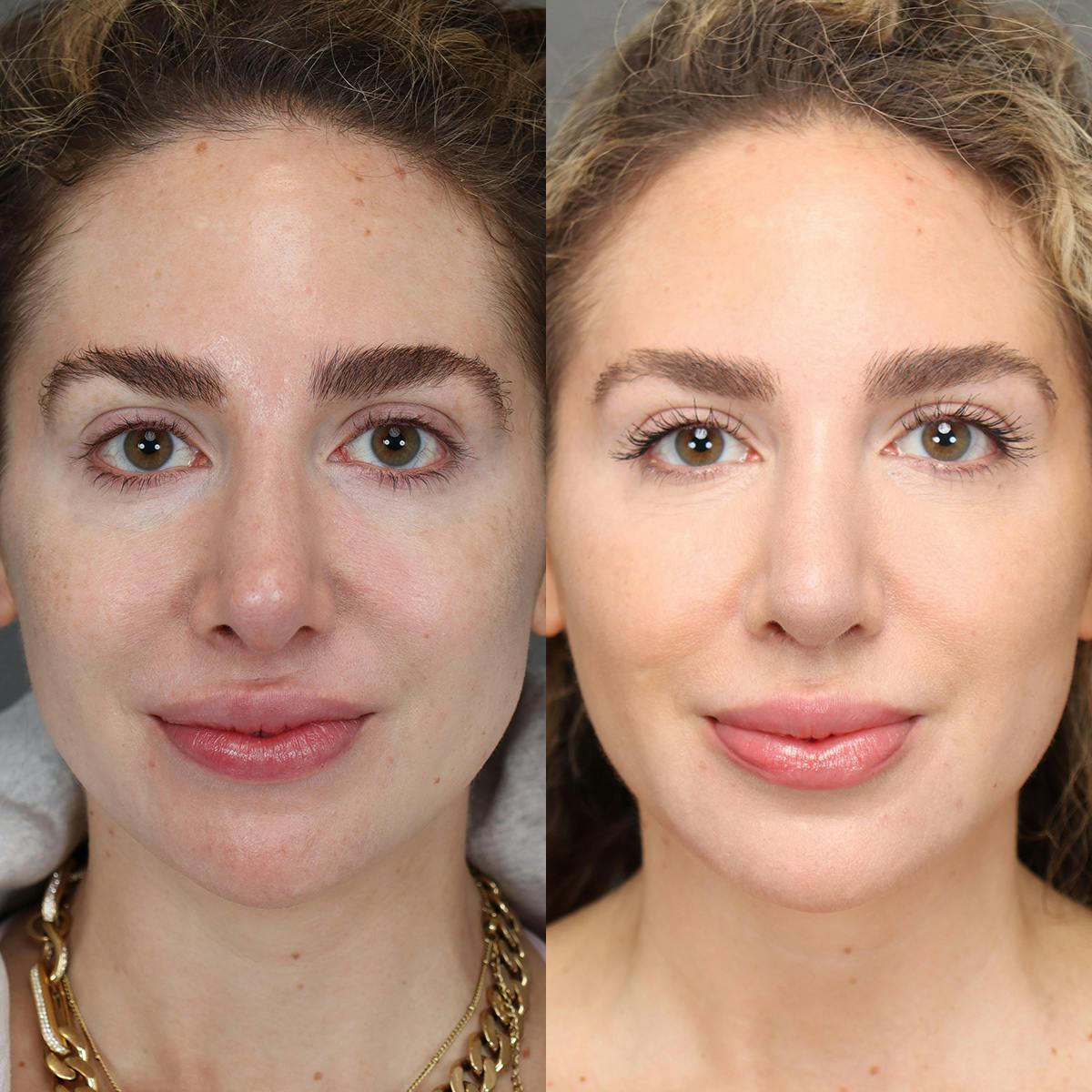 Revision Rhinoplasty Before & After Gallery - Patient 156925 - Image 3