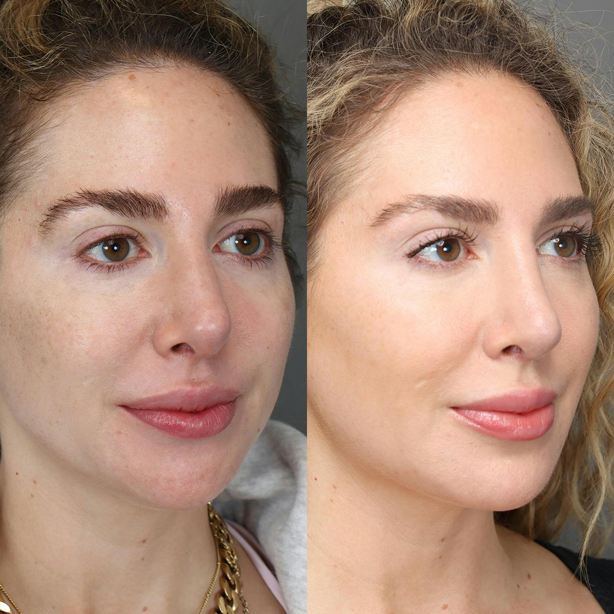 Revision Rhinoplasty Before & After Gallery - Patient 156925 - Image 2