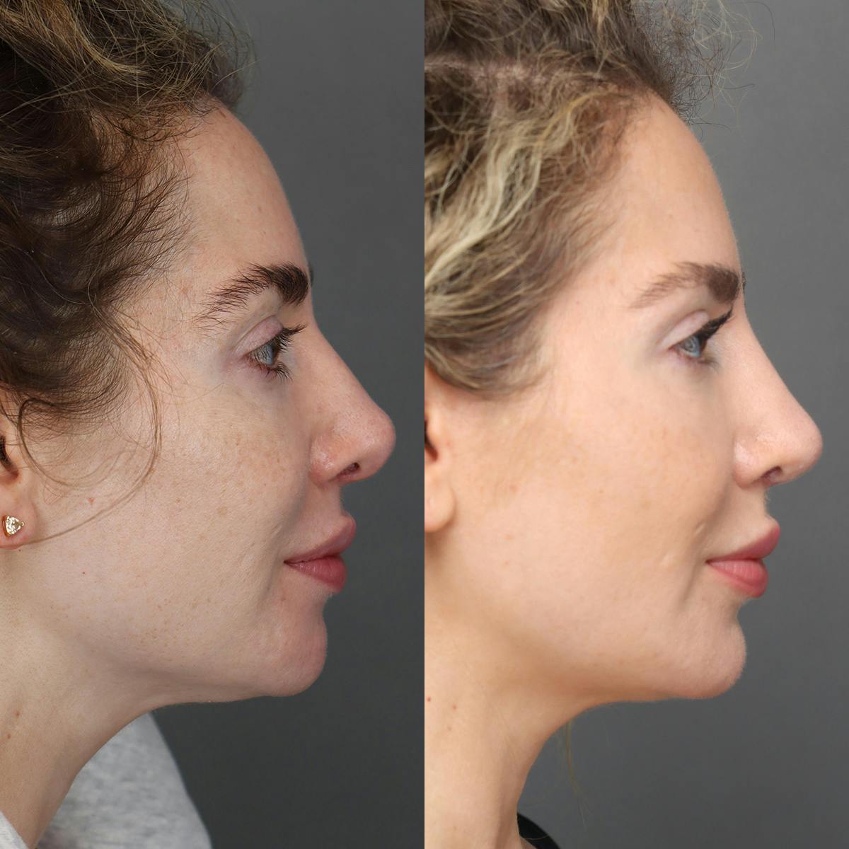 Revision Rhinoplasty Before & After Gallery - Patient 156925 - Image 1